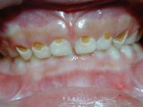 专家介绍三种龋齿治疗常见方法